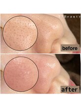ティーティービューティ 名古屋金山店(TTBeauty)/毛穴エクストラクション