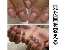 リフレシア(Rifrecia)/一瞬で見た目を変える深爪矯正