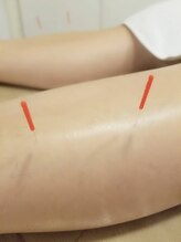 アルストロメリア/脚への刺鍼