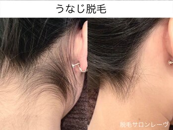 レーヴ/手の届かない所は脱毛がオススメ