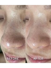 サロンドジェシカ(salon de Jessica)/毛穴洗浄