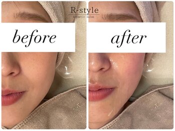 エステサロン アールスタイル(R-style)/テラボーラビフォーアフター写真