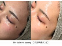 ザ ベルネス(The bellness)/【セルマン】肌改善・ピーリング