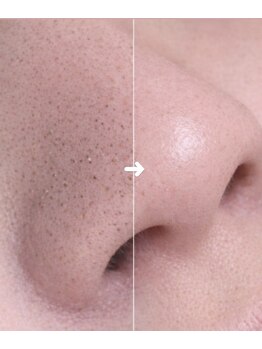 プレローマ(Pleroma)の写真/「何をしても繰り返す…」 そんなお悩みに◎毛穴の黒ずみ、いちご鼻、角栓など、ぜひ一度ご相談ください♪