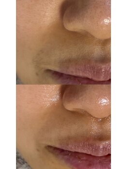 パタティパタタ(PatatiPatata)/WAX脱毛→VOSサロンケアで艶肌
