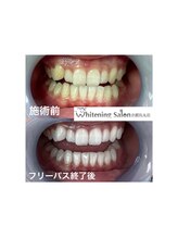 ホワイトニングサロン 京都烏丸店/ホワイトニングニング施術例