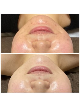 ヴァロ(Valo)/Eライト+高濃度ビタミンC導入