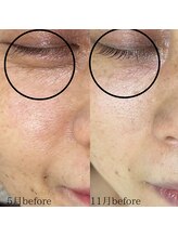 サロン ド エン(Salon de. en)/たるみケア◇ハーブピーリング