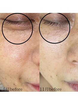 サロン ド エン(Salon de. en)/たるみケア◇ハーブピーリング