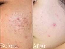 サージュクロレ 松戸店(sage colorer)/クリスタルハーブピーリング