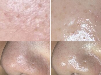 コハク(kohaku)/ララピール+エレポ b/a