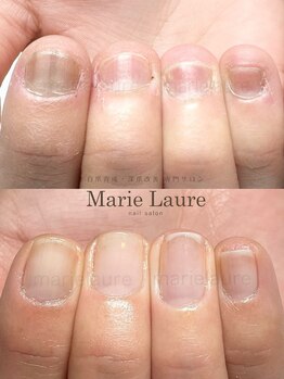 マリーロール 天王寺店(Marie Laure)/深爪改善/自爪育成/ネイルケア