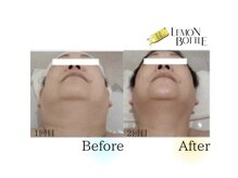 クリニカルエステ イーズ 広島祇園店/FACE☆レモンボトル体験☆