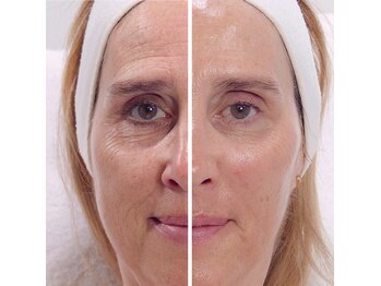 セントセシリア/VAR毛細血管10％復活！温熱機器