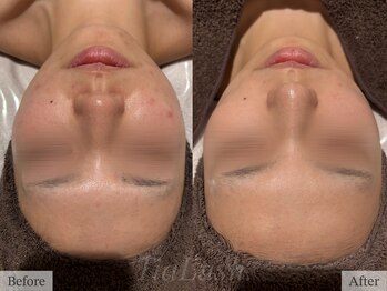 ティアラッシュ(TiaLash)/ハーブピーリング