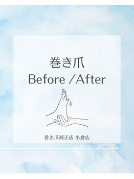 巻き爪補正店 小倉店/【巻き爪/陥入爪】