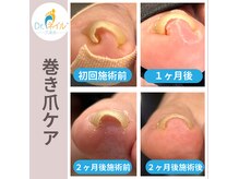 ドクターネイル爪革命 群馬両毛店の雰囲気（巻き爪は形を整えながら数回通うことで、根本から楽になります♪）