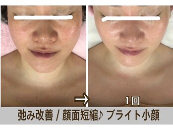 アルページュ(Arpege)の写真/韓国人気★エステ版チタニウムリフト【小顔輪郭×高ハリ×色白シミケア×毛穴レス】一度で叶う欲張り美容