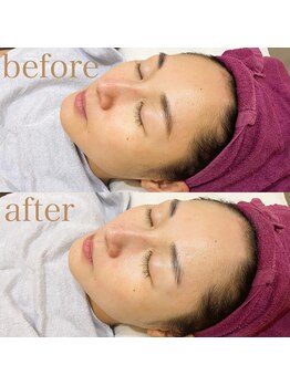 プラスキュア 用賀店(+CURE)/【フェイシャル】美肌パック