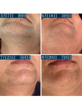 エクラ アン(eclat.un)/５０代男性：ヒゲ脱毛