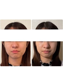 ミモザ 佐野(mimosa)/20代もっと小顔に