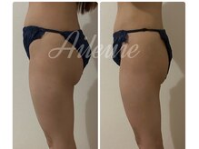 エルール トータルビューティ(Aileure total beauty)/インディバ痩身