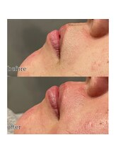 アデル 久留米(ADEL)/フェイシャルワックス《口周り》