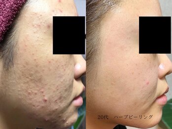 ボタニック 福津店(BoTANiC)/【ハーブピーリング】12回/20代