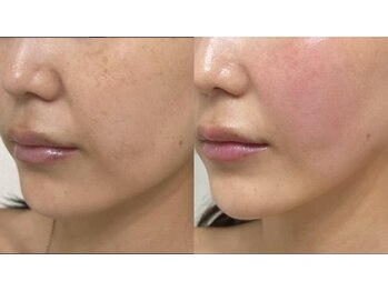 ワイグレイス(Y.GRACE)/エクラボーテフェイシャル