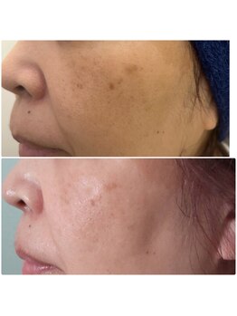 ビジュー(Bijou)/光フェイシャル