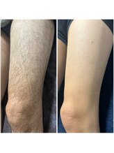 カナウ(KANAU)/脚脱毛すると痩せてみえる！