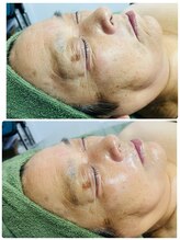 ナチュラルビューティラテ(NATURAL BEAUTY LATTE)/レチノールモニター