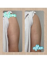 ベリーチェ(beliece)/《痩身》脂肪分解エステ／二の腕