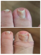 アンティ(Aunty)/巻き爪補正