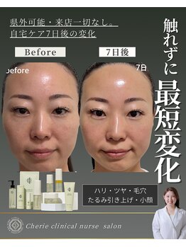 シェリー(Cherie)/話題インセルダム!小顔たるみ7日