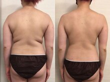 ジュメル 恵比寿店(Jumelles)/背中のたるみケア