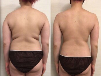 ジュメル 恵比寿店(Jumelles)/背中のたるみケア