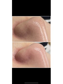 ティーティービューティ 名古屋金山店(TTBeauty)/毛穴エクストラクション