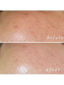 ルマエクレ(rmaecla)/ニキビ改善 カーボキシー