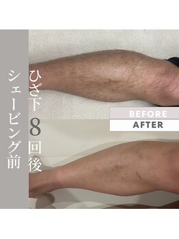 アイリビューティー専科(AIRIビューティー専科)/メンズ脱毛：ひざ下脱毛