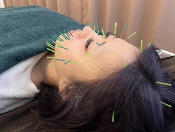 たんぽぽ整骨院鍼灸院/美容はり施術♪