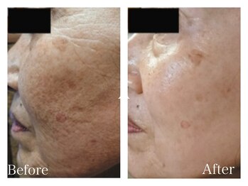 イヨヨ(iyoyo)/BeforeAfter