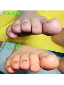 【肥厚・変形爪】ネイル/フット