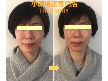 小顔矯正サロン セラフィ/もたつき・たるみのない小顔へ♪