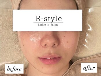 エステサロン アールスタイル(R-style)/半顔施術ビフォーアフター写真