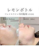 フラウ(Frau)/レモンボトル/フェイスライン