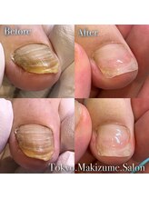 巻き爪補正店 越谷店/変形爪補正