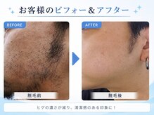 イン東京 青森浜田店/ヒゲ脱毛のビフォーアフター