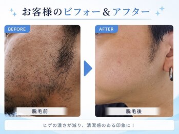 イン東京 青森浜田店/ヒゲ脱毛のビフォーアフター