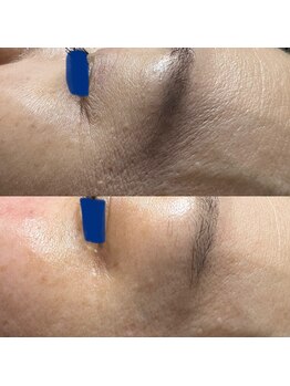 bou 新宿/乾燥もちりめんジワもさようなら